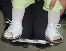 兒童足內(nèi)八字，外八字矯正