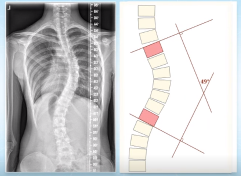 脊柱側(cè)彎的角度測(cè)量