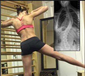 脊柱側(cè)彎的治療