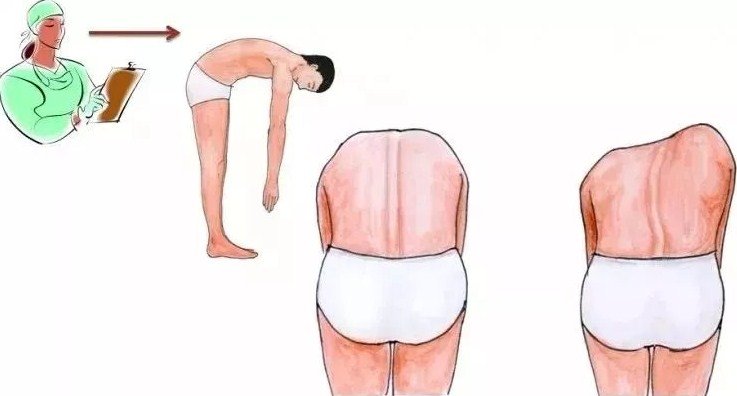 脊柱側(cè)彎早發(fā)現(xiàn)，早治療