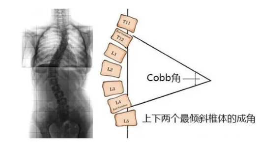 脊柱側彎角度怎么測量？