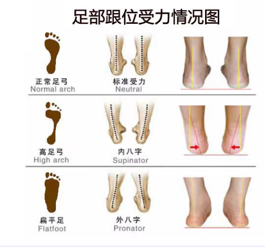 扁平足和脊柱側(cè)彎之間有關(guān)聯(lián)嗎？