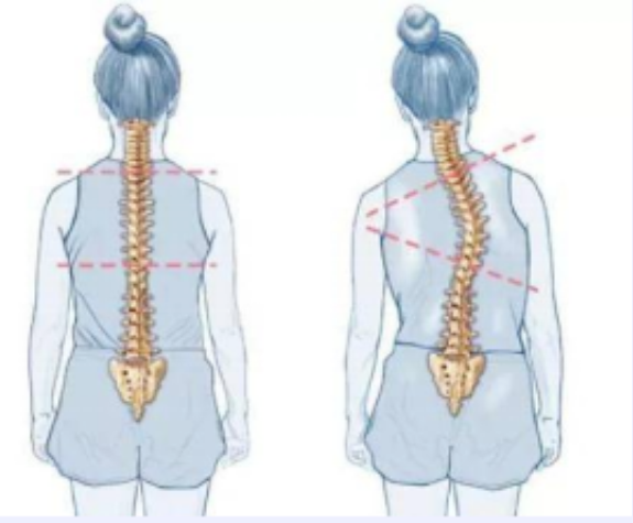 扁平足和脊柱側(cè)彎之間有關(guān)聯(lián)嗎？