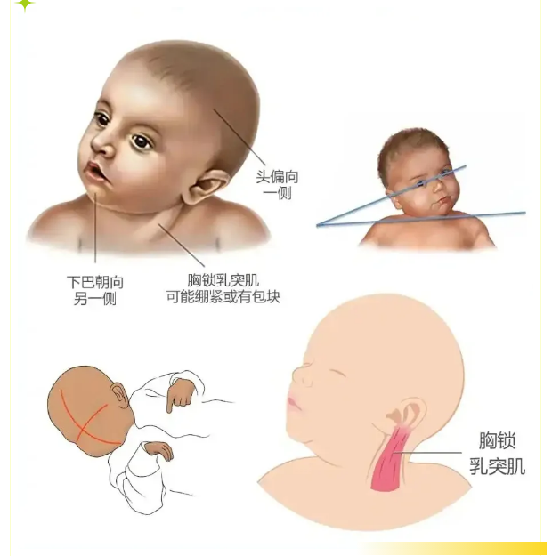 兒童斜頸的治療的