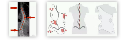 脊柱側(cè)彎支具