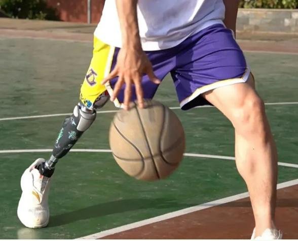 現代假肢的安裝