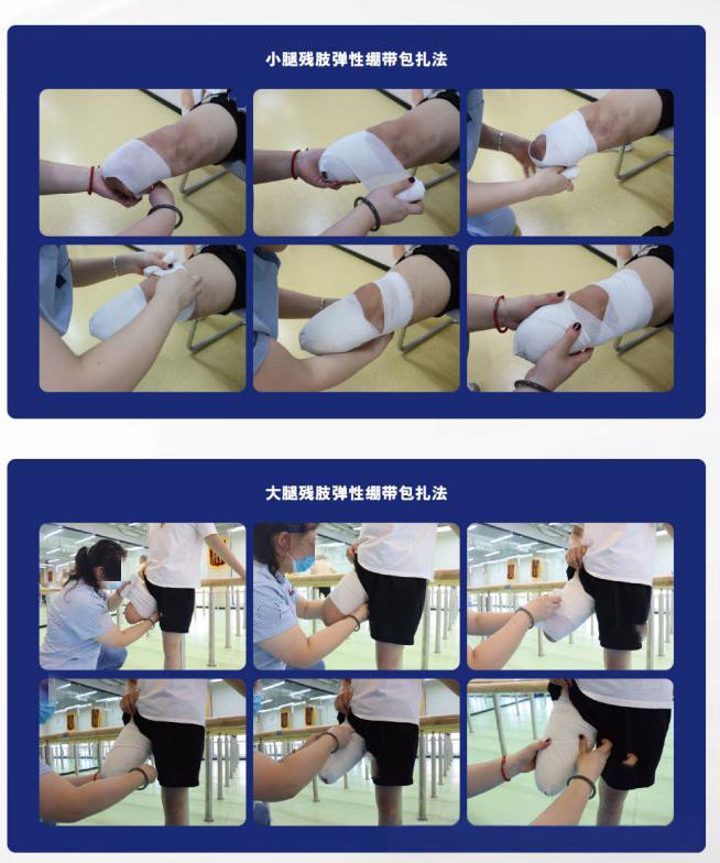 截肢術(shù)后的殘肢塑型